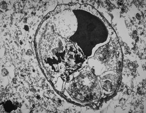 M, | cerebral cortex - malaric pigment M, | cerebral cortex - malaric pigment